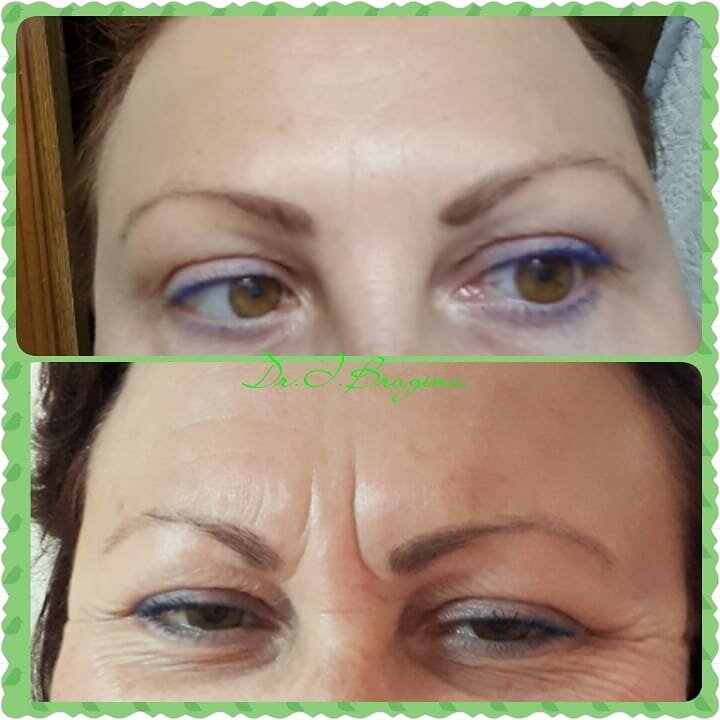 Ботокс в лоб