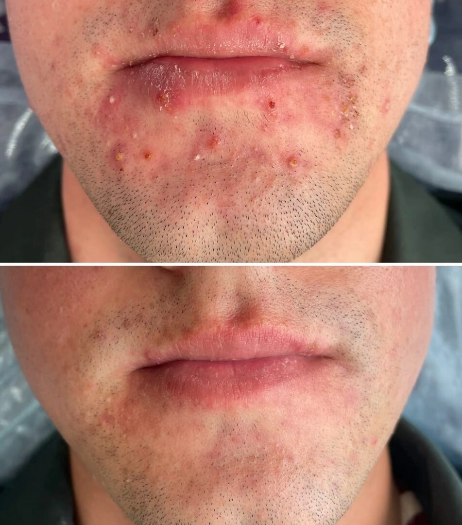 Лечение угревой сыпи