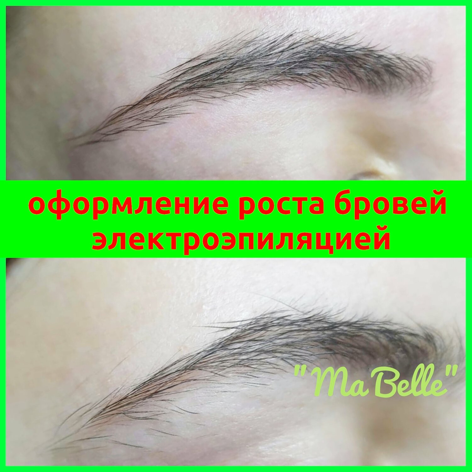 Электроэпиляция: брови