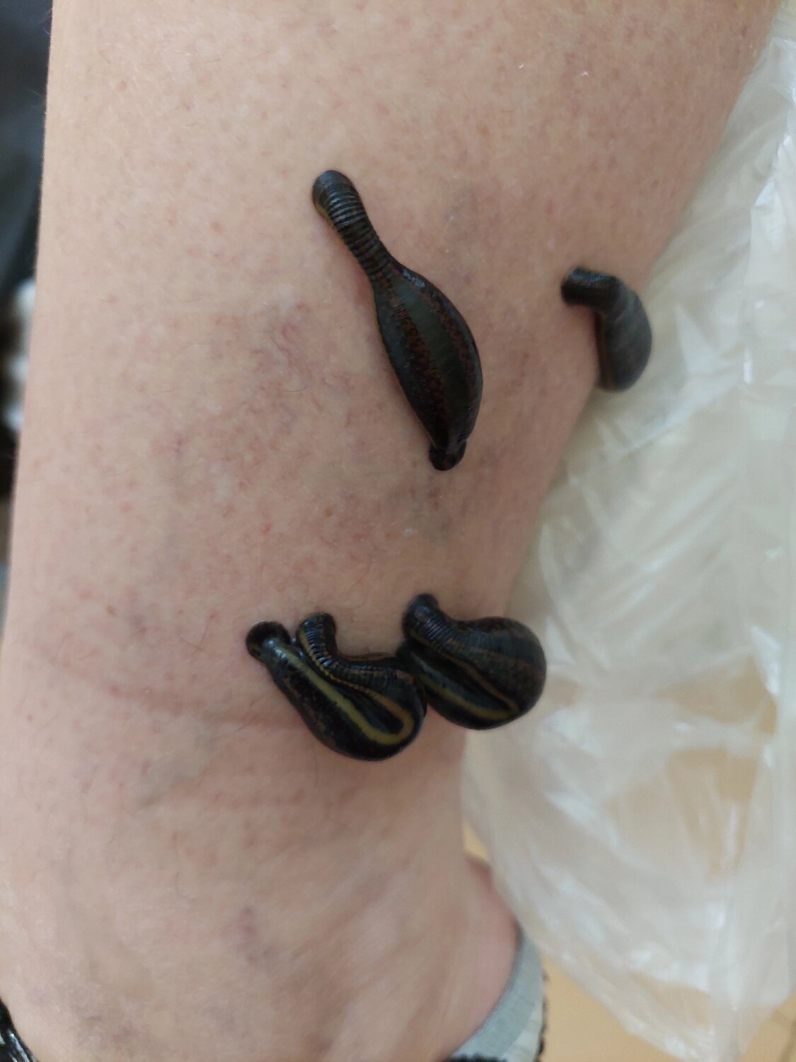 Оздоровление пиявками