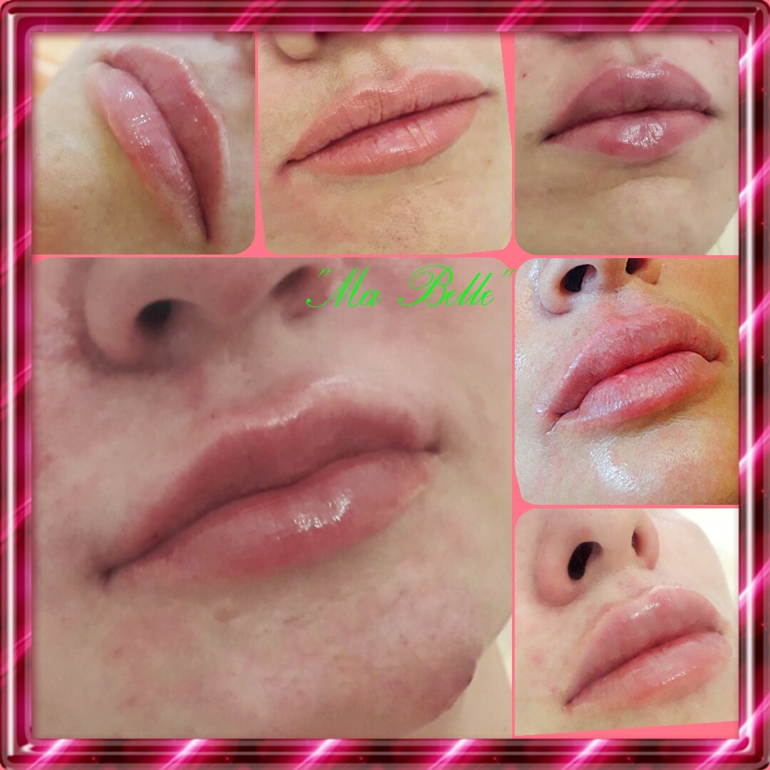 Увеличение губ