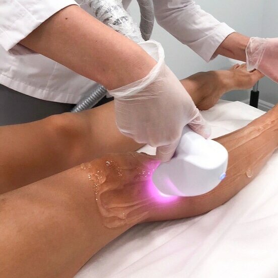 Лазерная эпиляция: голени