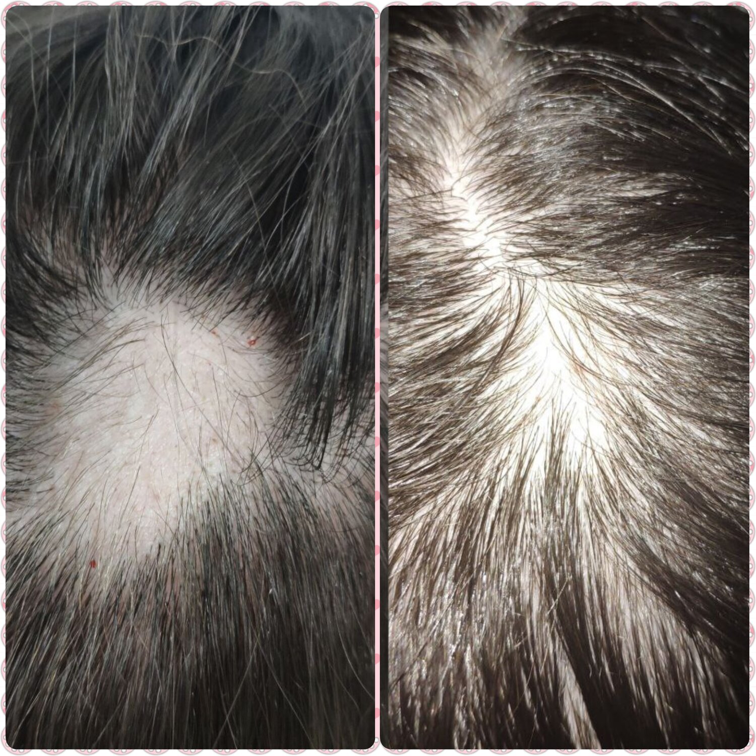 Карбокситерапия волос