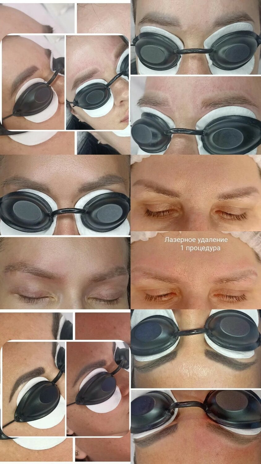 Лазерная коррекция бровей
